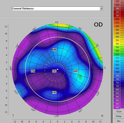 Pre-op pachymetry of diseased cornea  ophthalmic cases, keratoplasty, laser assisted keratoplasty, femtosecond laser, Fuchs endothelial dystrophy, top hat
